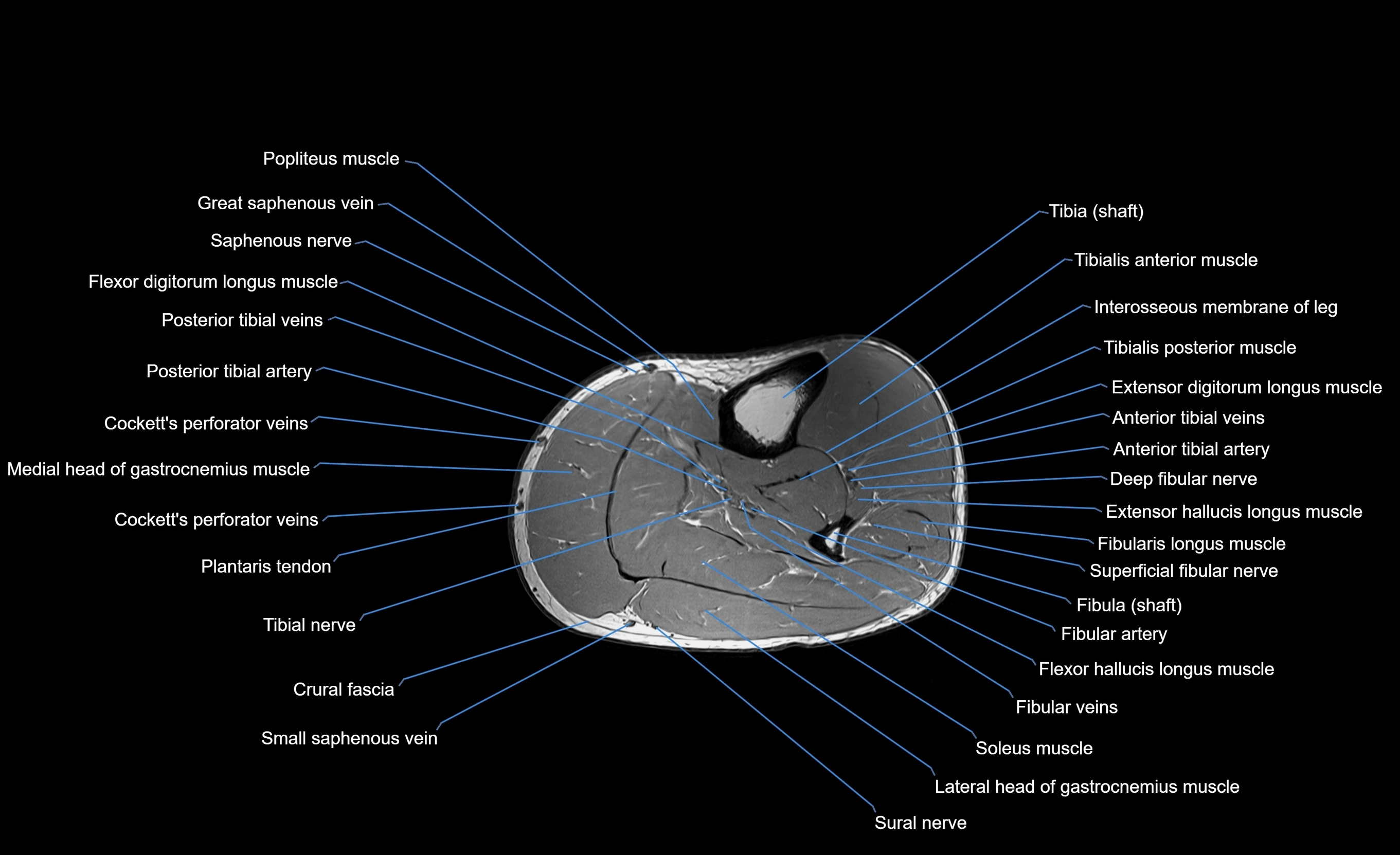 MRI lower leg axial cross sectional anatomy 3T  radiology  image-img-00001-00040.webp